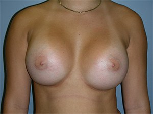 Breast Augmentation Before and After Pictures Miami, FL