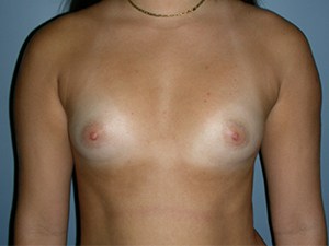 Breast Augmentation Before and After Pictures Miami, FL