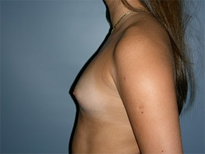 Breast Augmentation Before and After Pictures Miami, FL