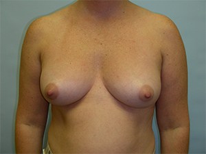 Breast Augmentation Before and After Pictures Miami, FL