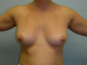 Breast Augmentation Before and After Pictures Miami, FL