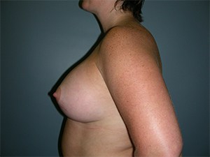 Breast Augmentation Before and After Pictures Miami, FL