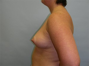 Breast Augmentation Before and After Pictures Miami, FL