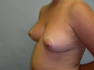 Breast Augmentation Before and After Pictures Miami, FL