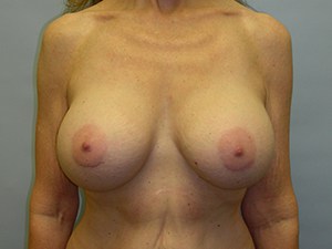 Breast Augmentation Before and After Pictures Miami, FL