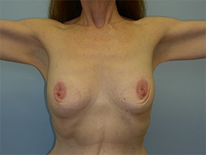 Breast Augmentation Before and After Pictures Miami, FL