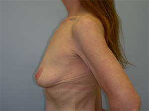 Breast Augmentation Before and After Pictures Miami, FL