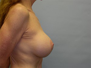 Breast Augmentation Before and After Pictures Miami, FL