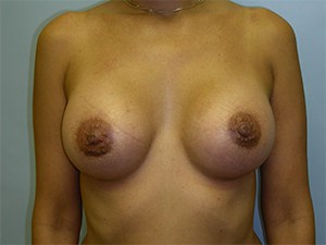 Breast Augmentation Before and After Pictures Miami, FL