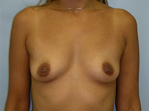 Breast Augmentation Before and After Pictures Miami, FL