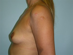 Breast Augmentation Before and After Pictures Miami, FL