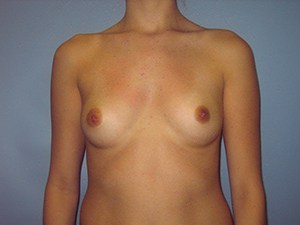 Breast Augmentation Before and After Pictures Miami, FL