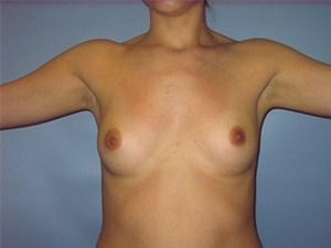 Breast Augmentation Before and After Pictures Miami, FL