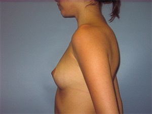 Breast Augmentation Before and After Pictures Miami, FL