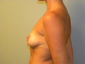 Breast Augmentation Before and After Pictures Miami, FL