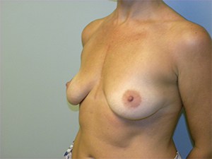 Breast Augmentation Before and After Pictures Miami, FL