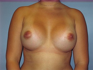 Breast Augmentation Before and After Pictures Miami, FL