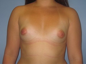 Breast Augmentation Before and After Pictures Miami, FL