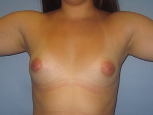 Breast Augmentation Before and After Pictures Miami, FL