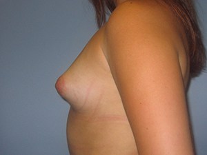 Breast Augmentation Before and After Pictures Miami, FL