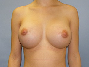 Breast Augmentation Before and After Pictures Miami, FL