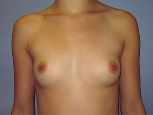 Breast Augmentation Before and After Pictures Miami, FL