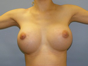 Breast Augmentation Before and After Pictures Miami, FL