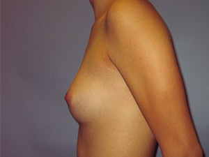 Breast Augmentation Before and After Pictures Miami, FL