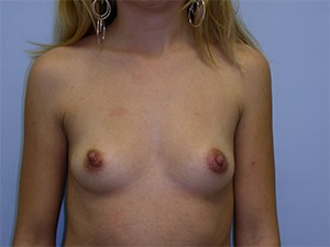 Breast Augmentation Before and After Pictures Miami, FL