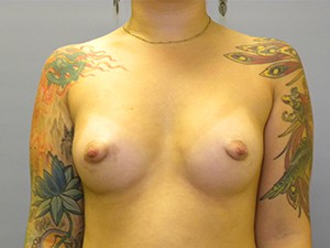 Breast Augmentation Before and After Pictures Miami, FL