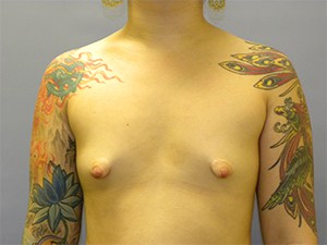 Breast Augmentation Before and After Pictures Miami, FL