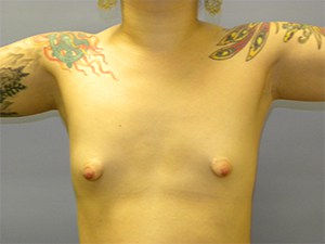 Breast Augmentation Before and After Pictures Miami, FL