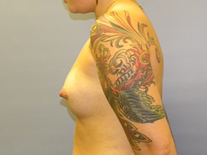 Breast Augmentation Before and After Pictures Miami, FL