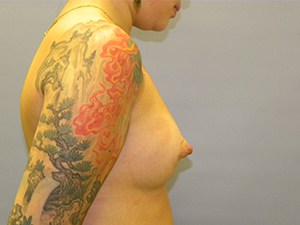 Breast Augmentation Before and After Pictures Miami, FL