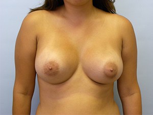 Breast Augmentation Before and After Pictures Miami, FL