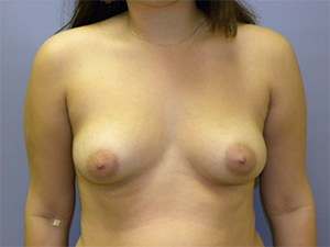 Breast Augmentation Before and After Pictures Miami, FL