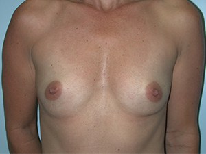 Breast Augmentation Before and After Pictures Miami, FL