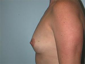 Breast Augmentation Before and After Pictures Miami, FL