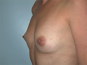 Breast Augmentation Before and After Pictures Miami, FL