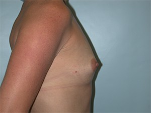 Breast Augmentation Before and After Pictures Miami, FL