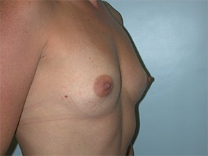 Breast Augmentation Before and After Pictures Miami, FL