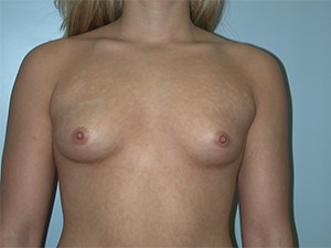 Breast Augmentation Before and After Pictures Miami, FL