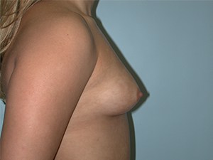 Breast Augmentation Before and After Pictures Miami, FL