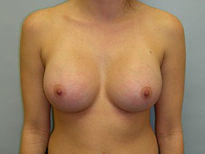 Breast Augmentation Before and After Pictures Miami, FL