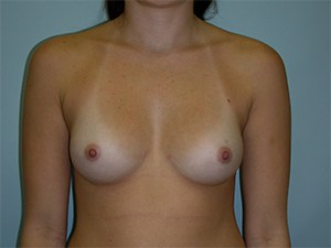 Breast Augmentation Before and After Pictures Miami, FL