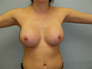 Breast Augmentation Before and After Pictures Miami, FL