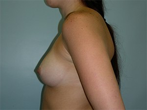 Breast Augmentation Before and After Pictures Miami, FL