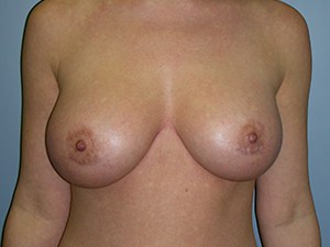 Breast Augmentation Before and After Pictures Miami, FL