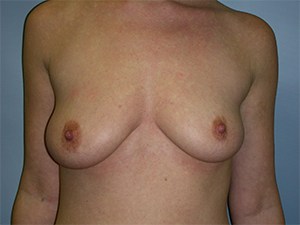 Breast Augmentation Before and After Pictures Miami, FL