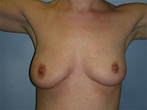 Breast Augmentation Before and After Pictures Miami, FL